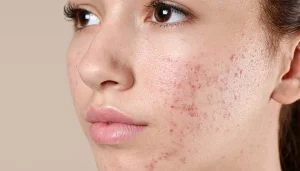 چگونه چربی پوست را کنترل کنیم