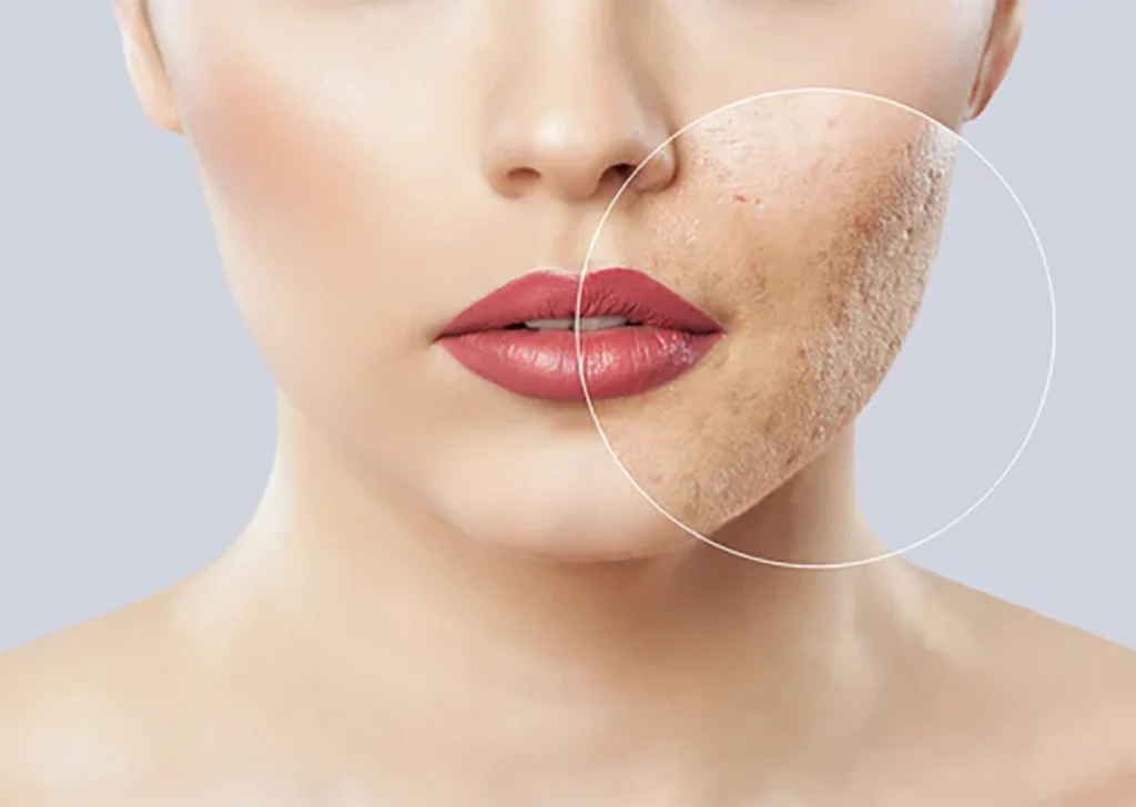 علل ایجاد چوش بعداز ارایش 1