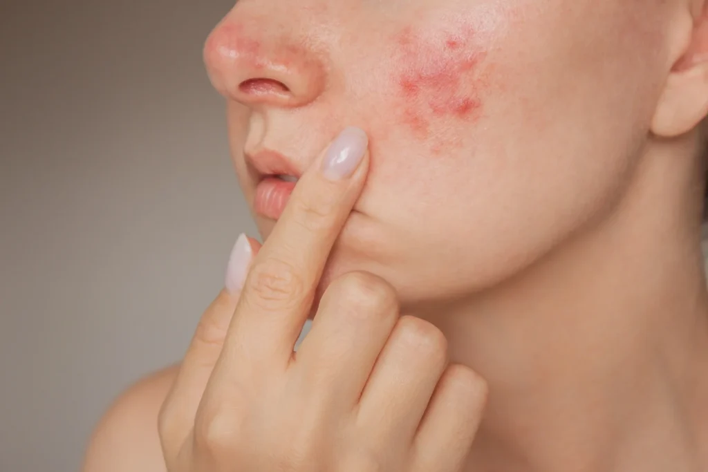 علل ایجاد چوش بعداز ارایش 2